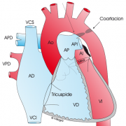 coartacion de aorta cardiopatias congenitas bihotzez