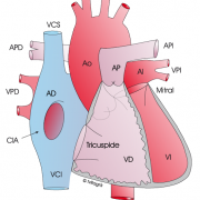 comunicacion interauricular cardiopatias congenitas bihotzez
