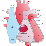 comunicacion interventricular cardiopatias congenitas bihotzez
