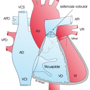 estenosis pulmonar cardiopatias congenitas bihotzez