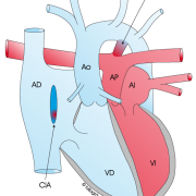 transposicion de las grandes arterias cardiopatias congenitas bihotzez